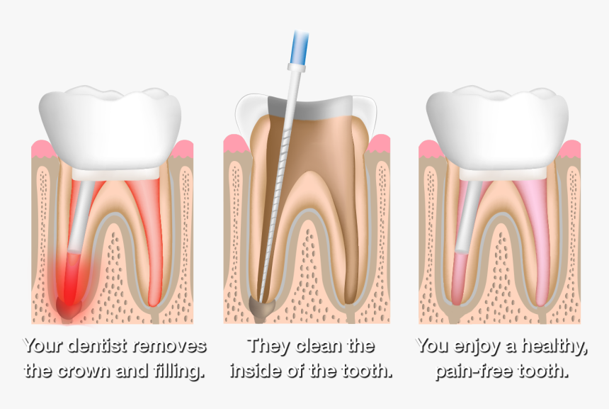 Root Canal Therapy, HD Png Download