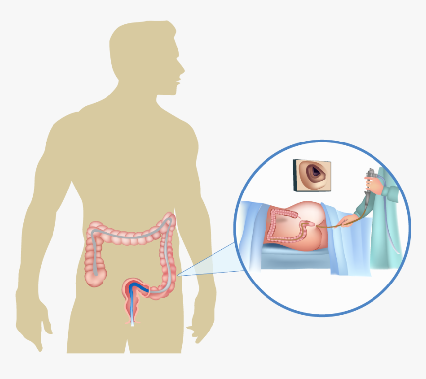 Colonoscopy, HD Png Download