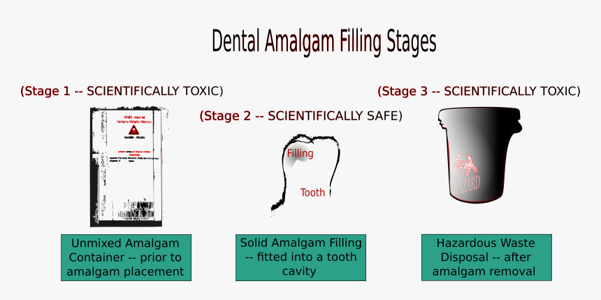 Dental Amalgam Filling Stages Clip Arts, HD Png Download
