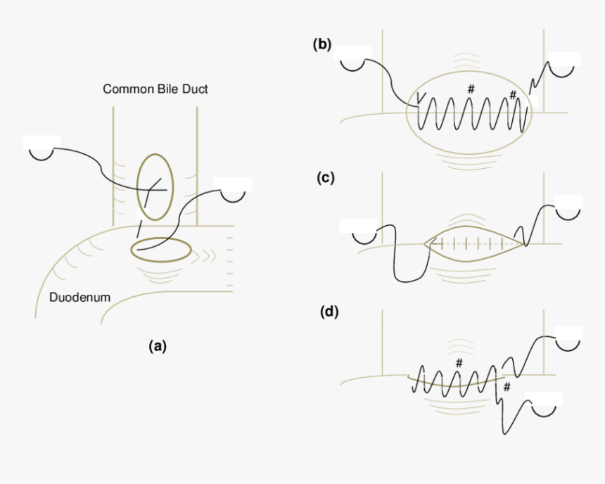Choledochoduodenostomy Suturing, HD Png Download