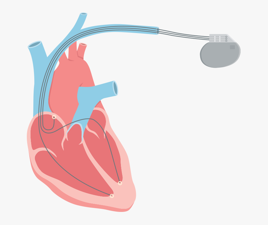 Systolic Romeo Landinez Co - Heart Failure Png, Transparent Png