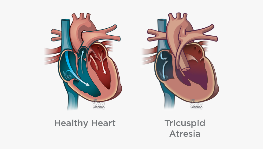 Tricusp#atresia - Truncus Arteriosus Heart, HD Png Download