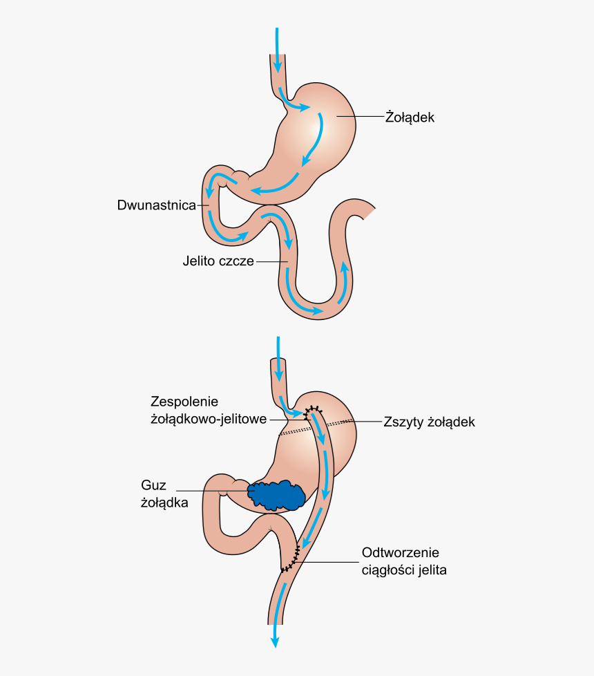 Diagram Showing Before And After Stomach Bypass Surgery, HD Png Download