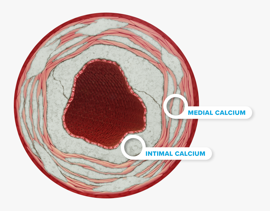 Calcium Right - Intimal Calcium, HD Png Download
