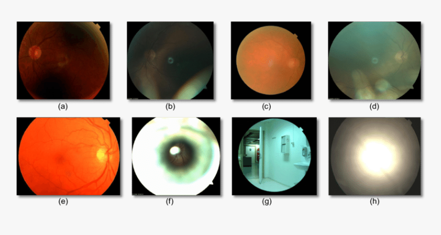 Poor Quality Of Fundus, HD Png Download