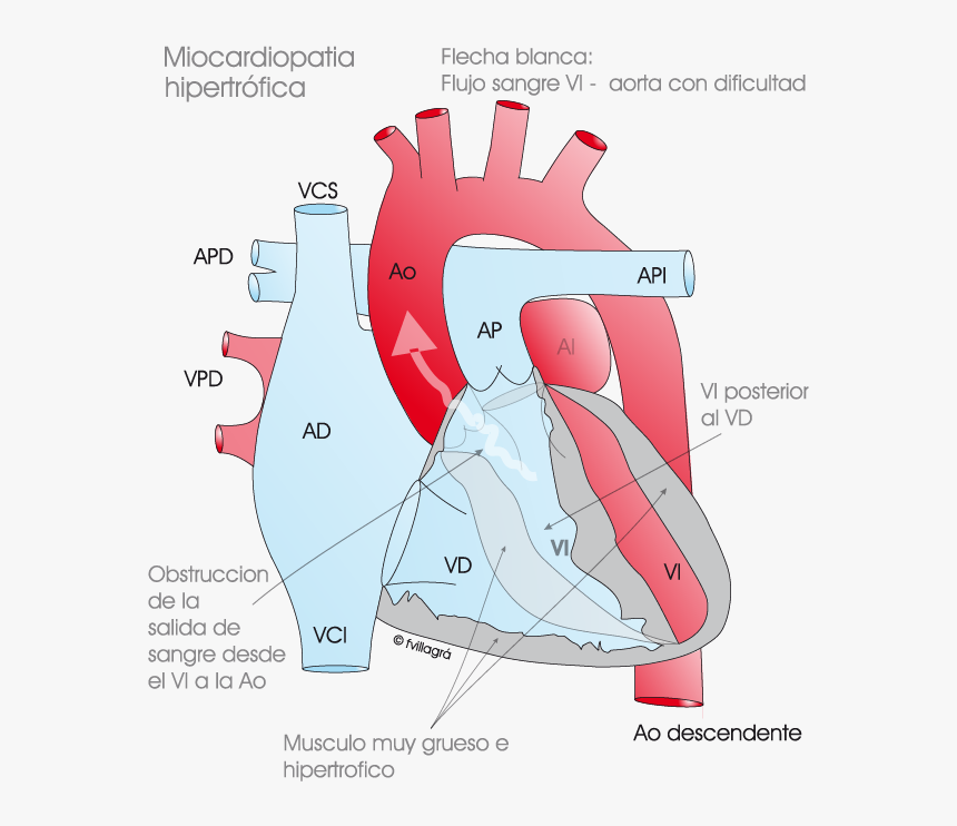 Tetralogia De Fallot Cirugia, HD Png Download