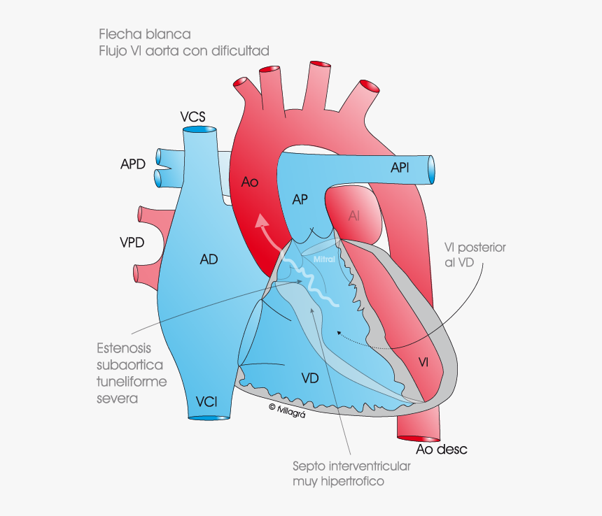 Cirugia De Konno, HD Png Download