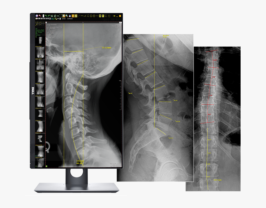 Chiropractic X Ray Machines, HD Png Download