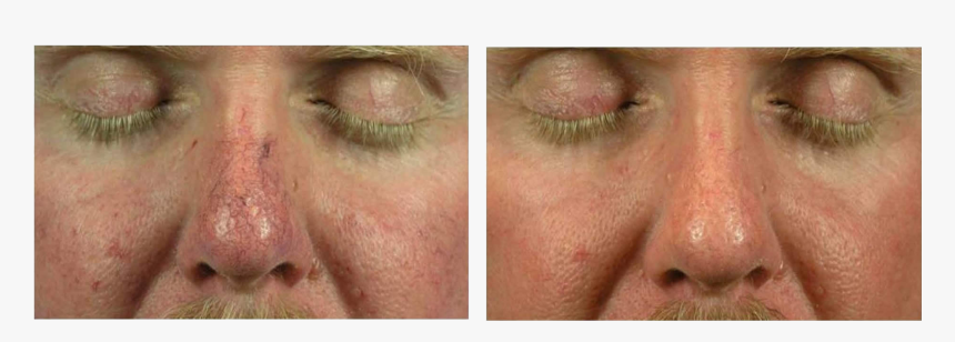 Photo Rejuvenation Skin Tightening - Facial Expression, HD Png Download