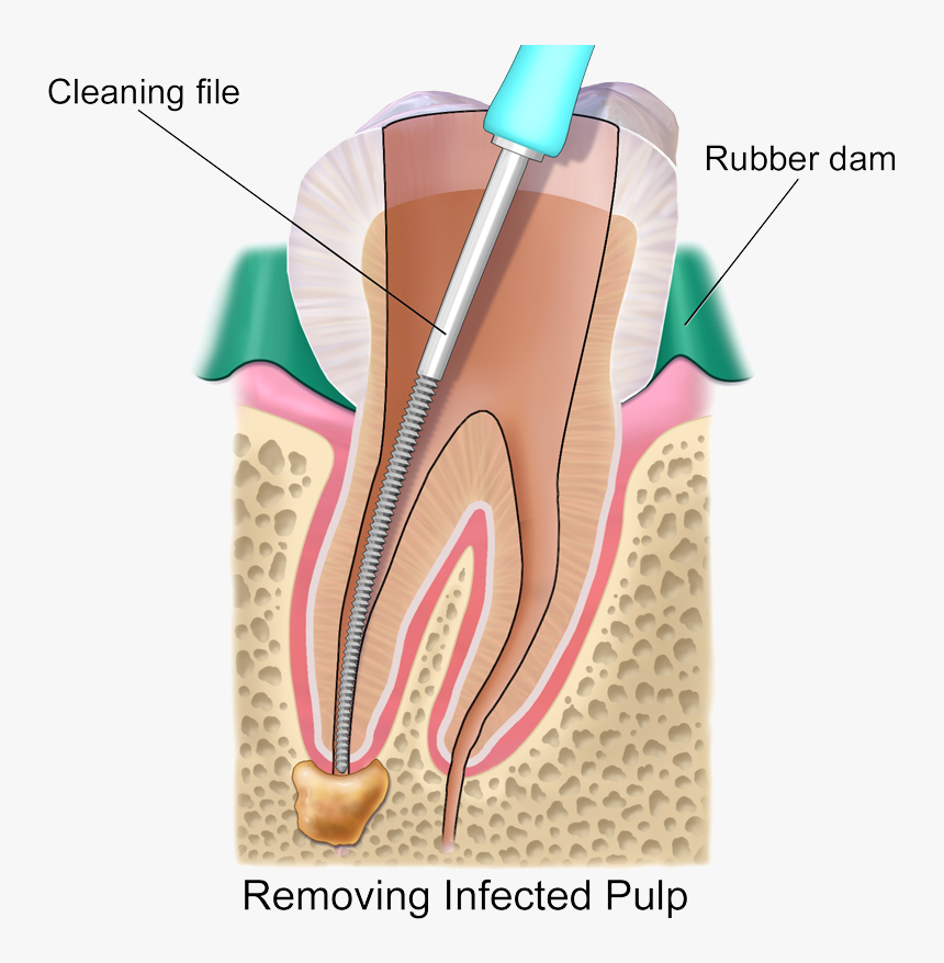 Transparent Nerves Png - ถุง หนอง ปลาย รากฟัน, Png Download