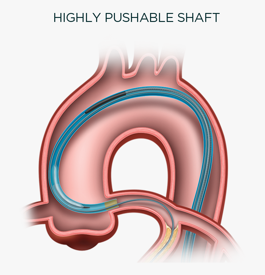 The Trapit Balloon Catheter Is Indicated To Facilitate - Imds Trapit, HD Png Download