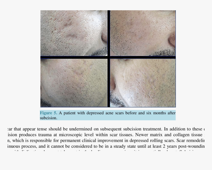 A Patient With Rolling & Icepick Acne Scars Before - Subcision On Trauma Scars, HD Png Download