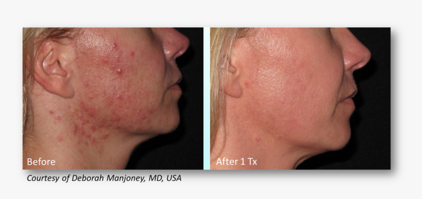 Manjoney - Infini Acne Scars Before And After, HD Png Download