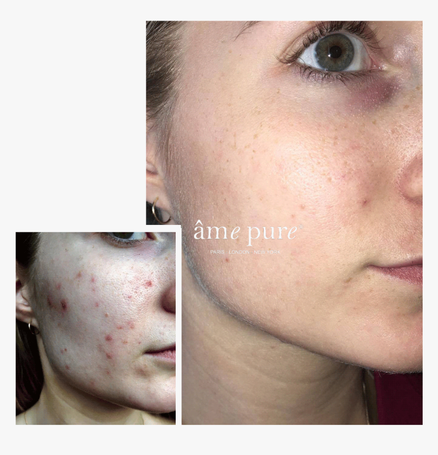 Ame Pure Before And After, HD Png Download