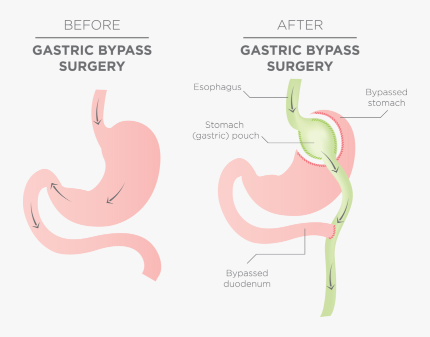 Stomach Before And After Gastric Bypass, HD Png Download