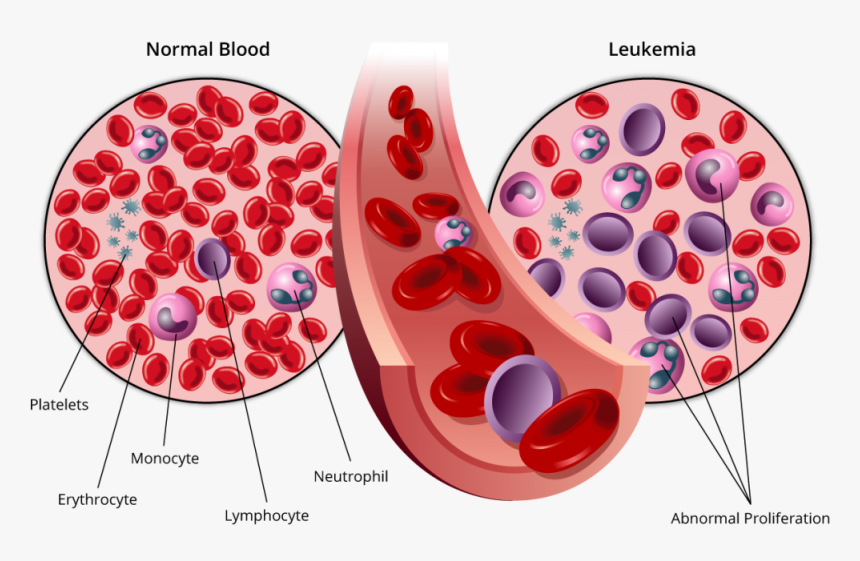 Blood Cancer, HD Png Download