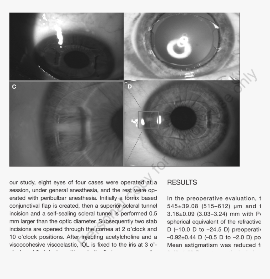 Dilated Pupil - Close-up - Close-up, HD Png Download