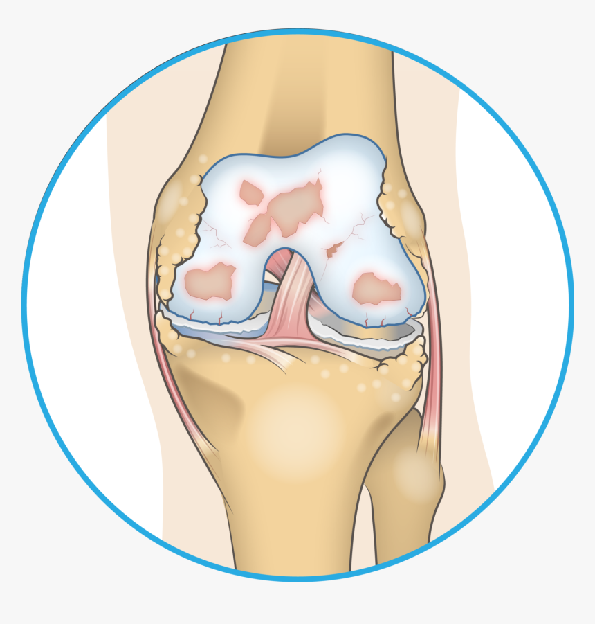 Bone Spur In Knee, HD Png Download