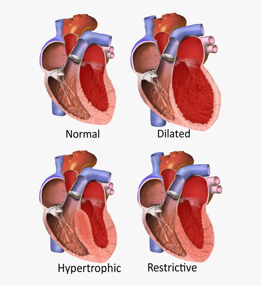 Major Categories Of Cardiomyopathy - Different Cardiomyopathies, HD Png Download