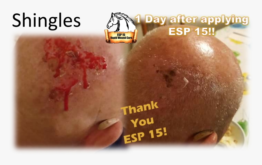 Esp 15 Used On Shingles On The Back Of A Man S Head - Bun, HD Png Download