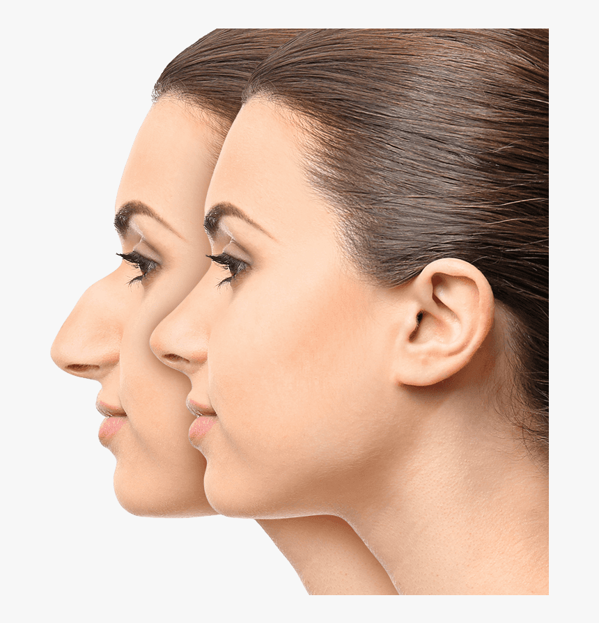 Modelos De Nariz Para Rinoplastia , Png Download - Nasal Dorsal Hump, Transparent Png
