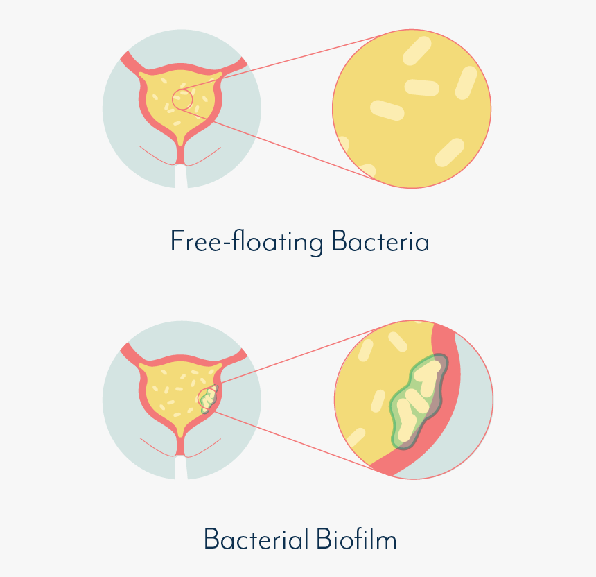 Chronic Urinary Tract Infection - Urinary Tract Infection Png, Transparent Png