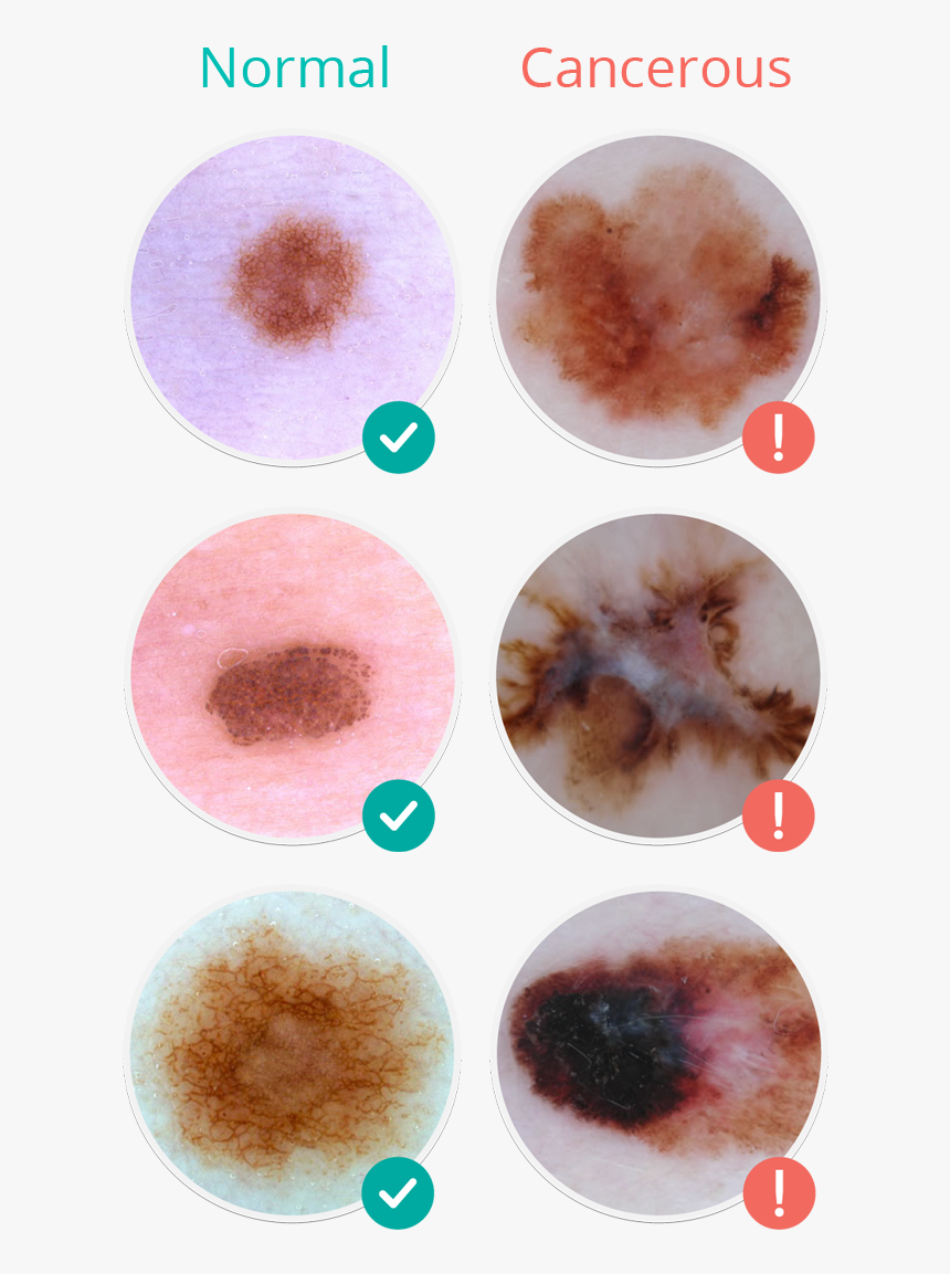 Photo Content - Skin Cancer Mole, HD Png Download