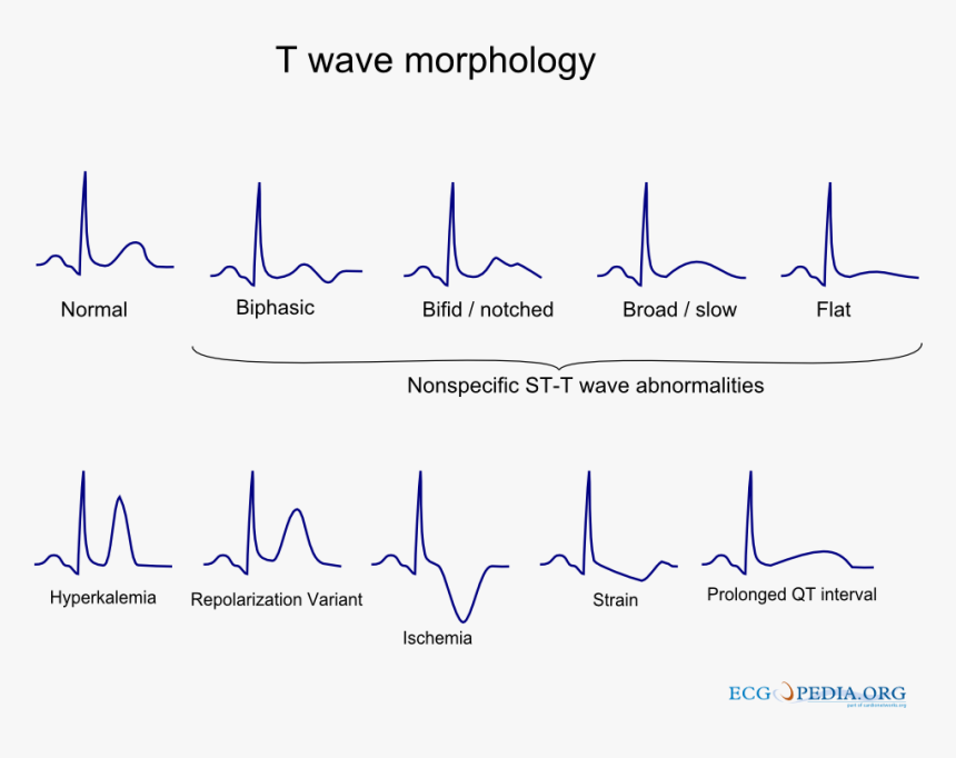 T Wave Abnormality, HD Png Download