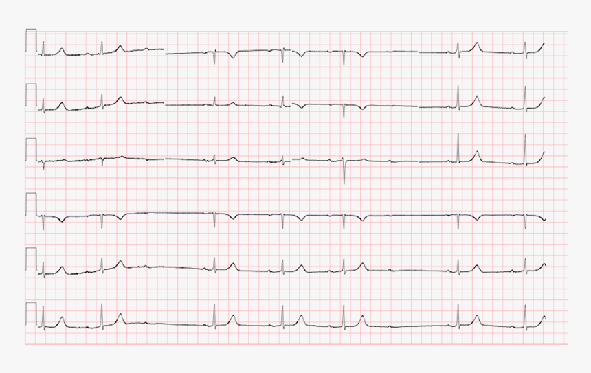Conduction Ecg - First Degree Av Block Sinus Bradycardia, HD Png Download