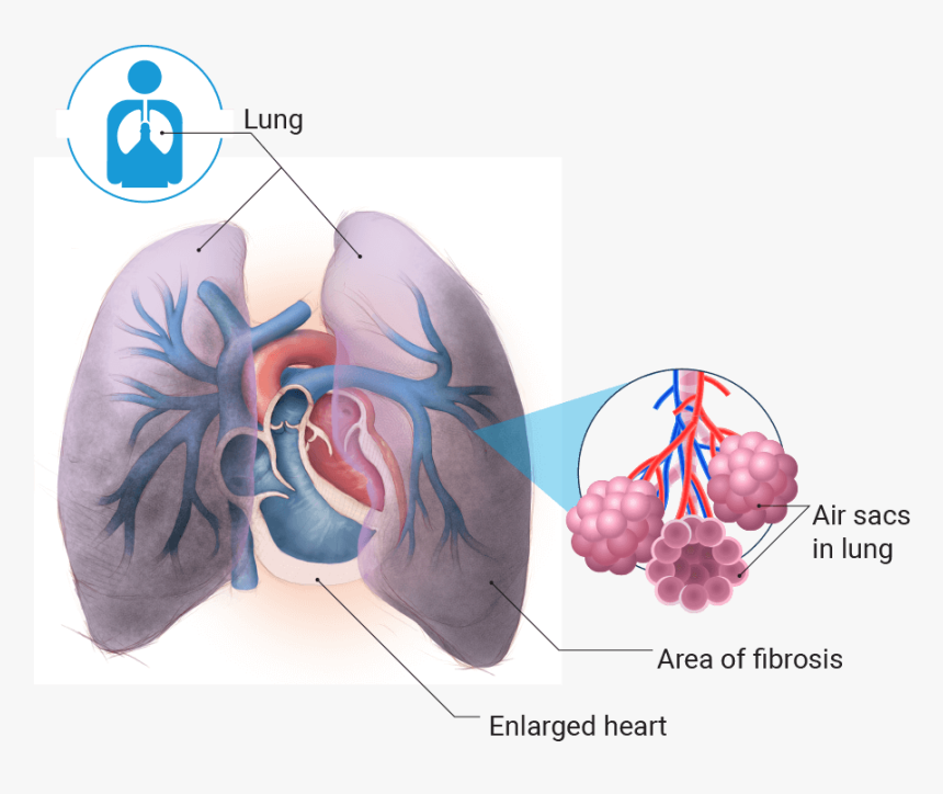 Transparent Lung Png - Pulmonary Hypertension Png Transparent, Png Download