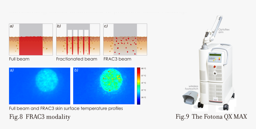 Transparent Laser Effect Png - Fotona Laser, Png Download