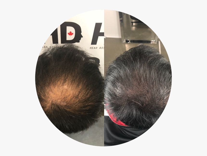 Photo02 - Lace Wig, HD Png Download