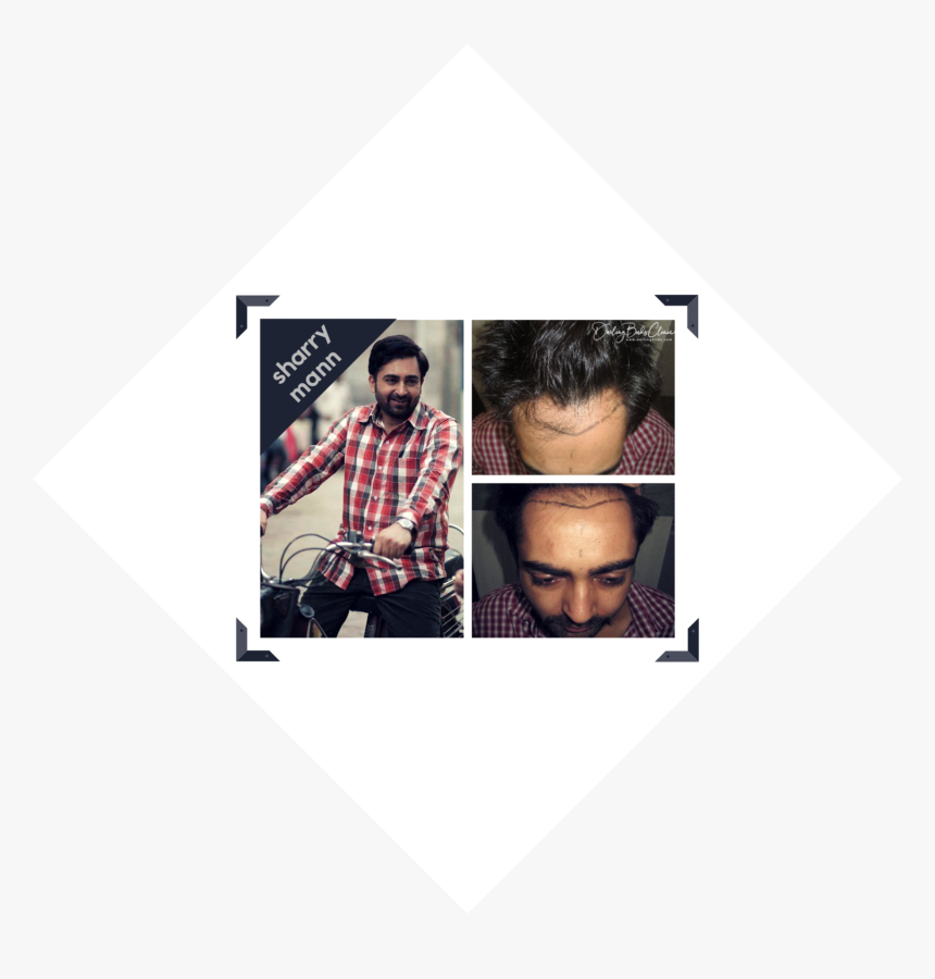 Sharry Mann Hair Transplant - Coffee, HD Png Download