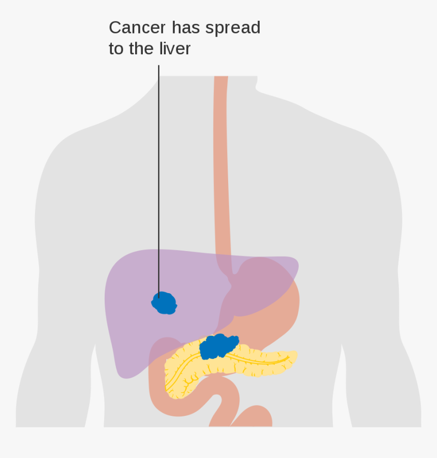 Illustration Pancreatic Cancer, HD Png Download