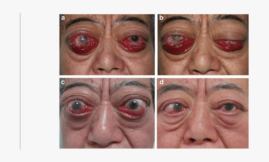 Old Man Face Png -ophthalmologic Symptoms Of The Patient - Orbital Decompression Graves, Transparent Png