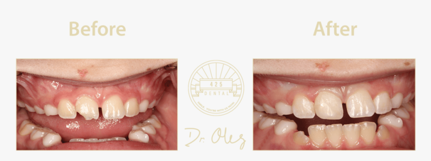 425 Before After Cosmetic22 - Tongue, HD Png Download