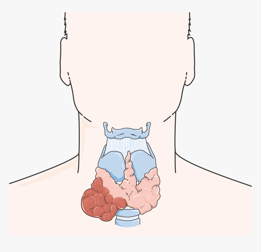 Cancer De La Thyroïde - Thyroid Cancer Cartoon, HD Png Download