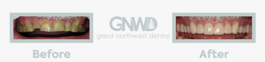 1teeth - Invisalign Before And After Wdult, HD Png Download