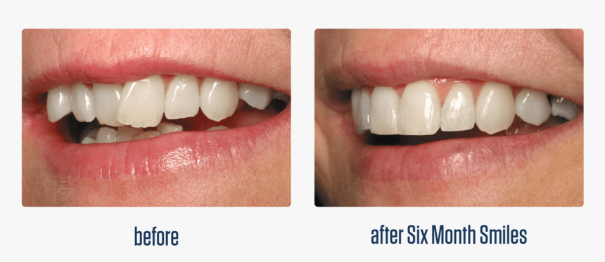 Transparent Smiling Mouth Clipart - Six Month Smiles, HD Png Download