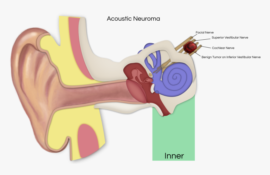 Vestibular Schwannoma Affected Nerves, HD Png Download