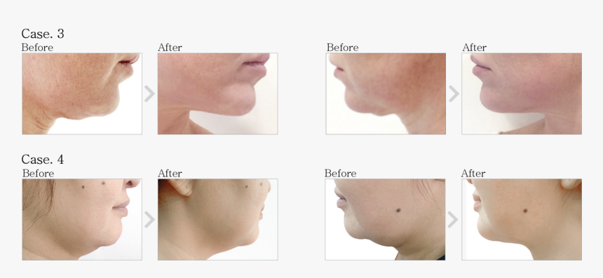 Prostrolane Inner B Before And After, HD Png Download