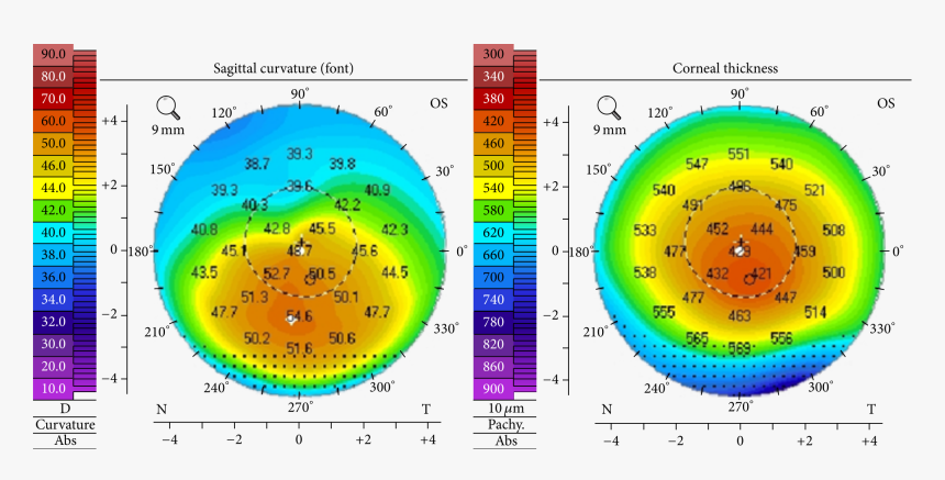 Corneal Topography Keratoconus, HD Png Download
