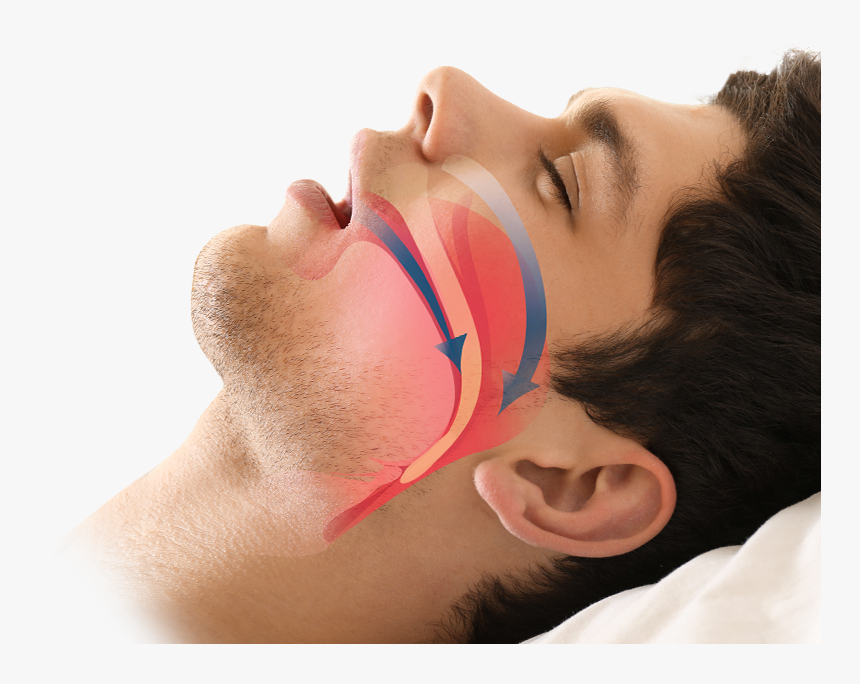 Man Sleeping - Surgery Sleep Apnea, HD Png Download