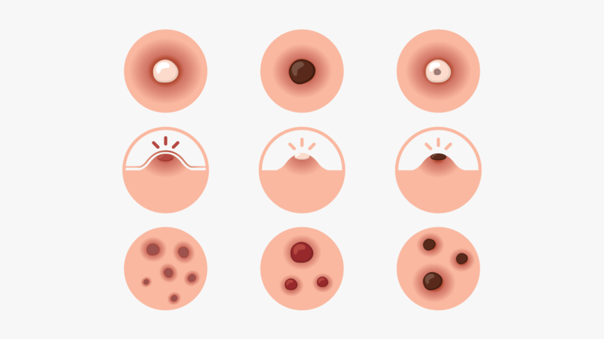 Pimple Icons Vector - Pimple Clipart, HD Png Download
