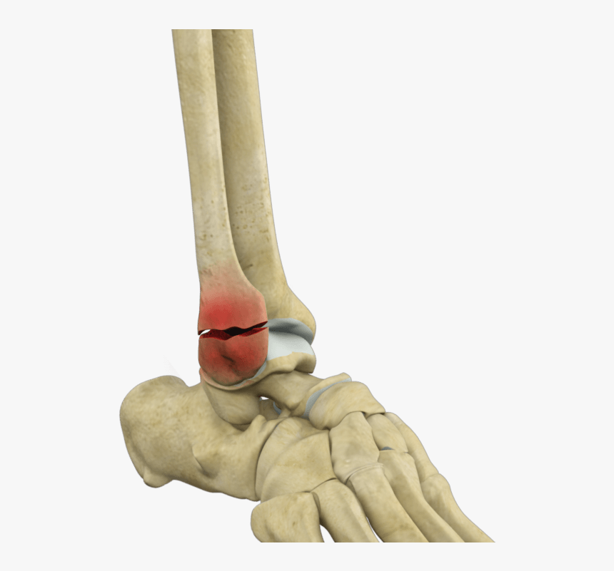 Ankle Fracture Repair Los Angeles - Fractured Ankle, HD Png Download