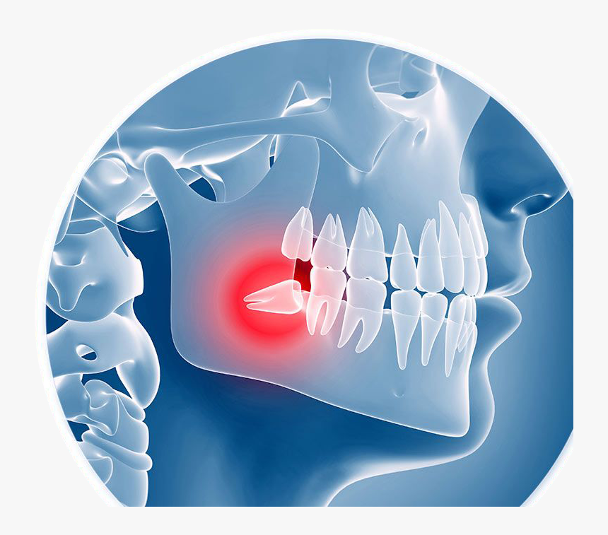 X-ray Illustration Of An Impacted Wisdom Tooth - Wisdom Teeth Removal, HD Png Download