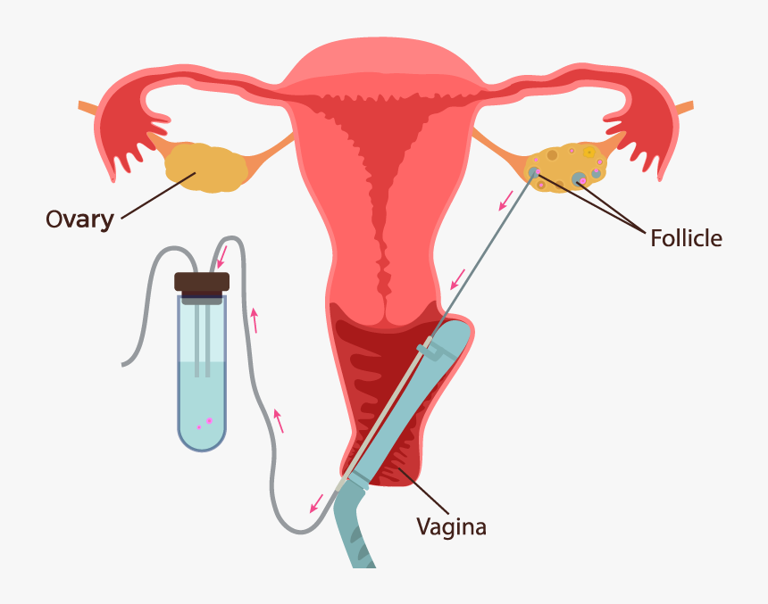 Ivf Process Step By Step - Ivf Egg Collection Process, HD Png Download