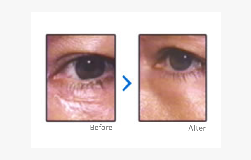 Contact Lens, HD Png Download