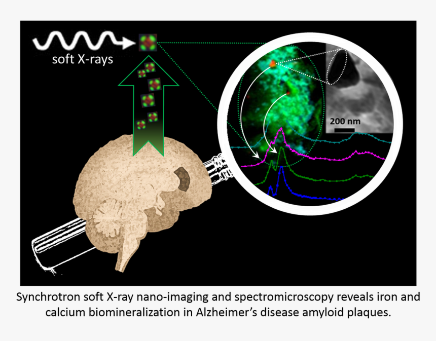 Iron Alzheimer's Disease, HD Png Download