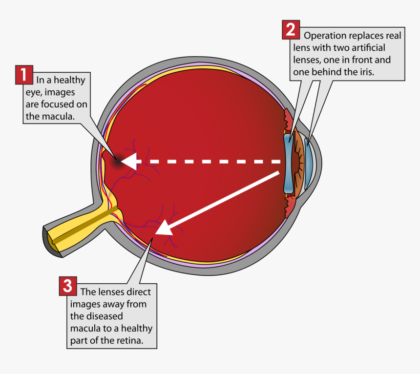 Implantable Miniature Telescope Diagram, HD Png Download